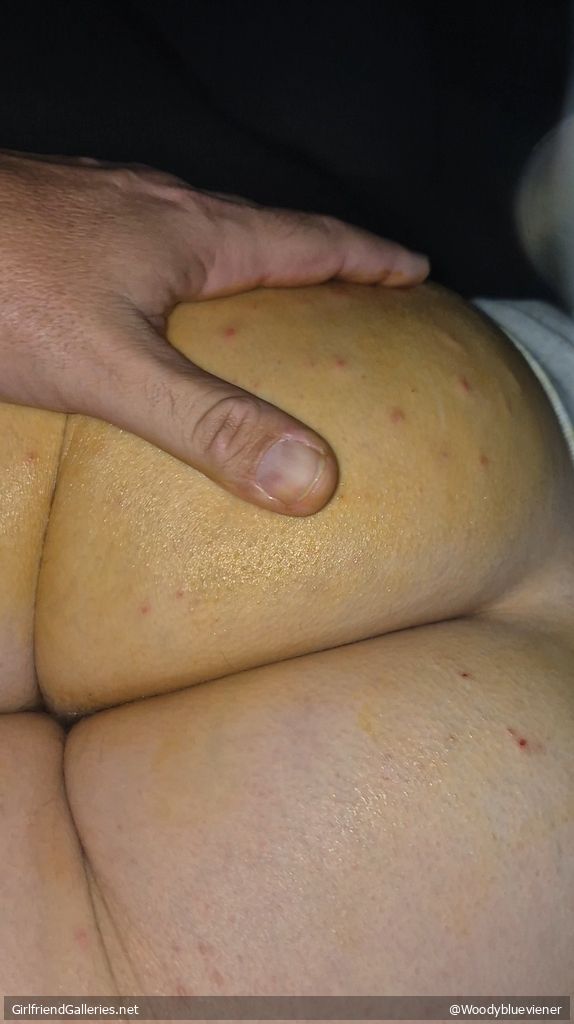 Wife's prickled bum