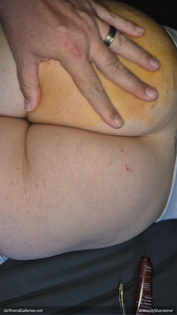Wife's prickled bum
